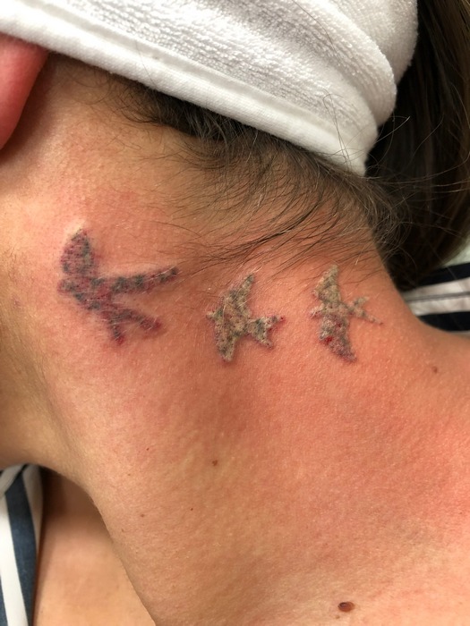 lézeres tetoválás eltávolítás 1. kezelés után