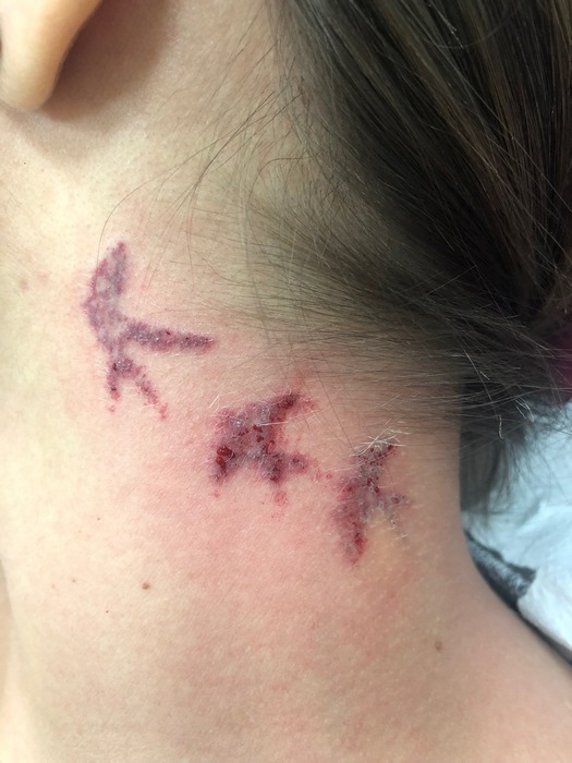 lézeres tetoválás eltávolítás 3. kezelés után